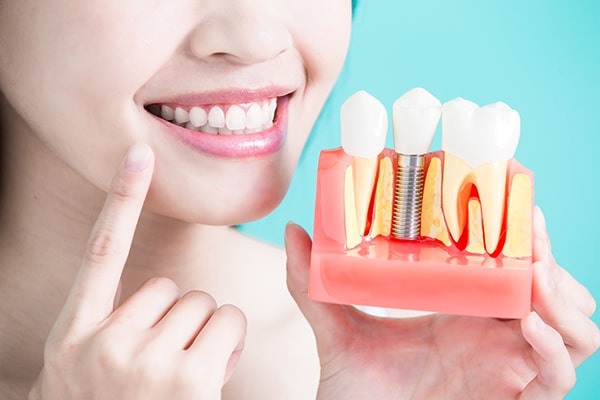clinica dra elisa fuentes implantes dentales